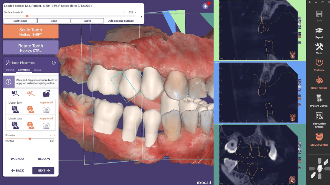 Faster tooth setup with Instant Anatomic Morphing.