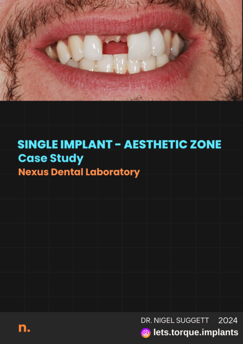 Dental implant case study, missing front tooth shown.