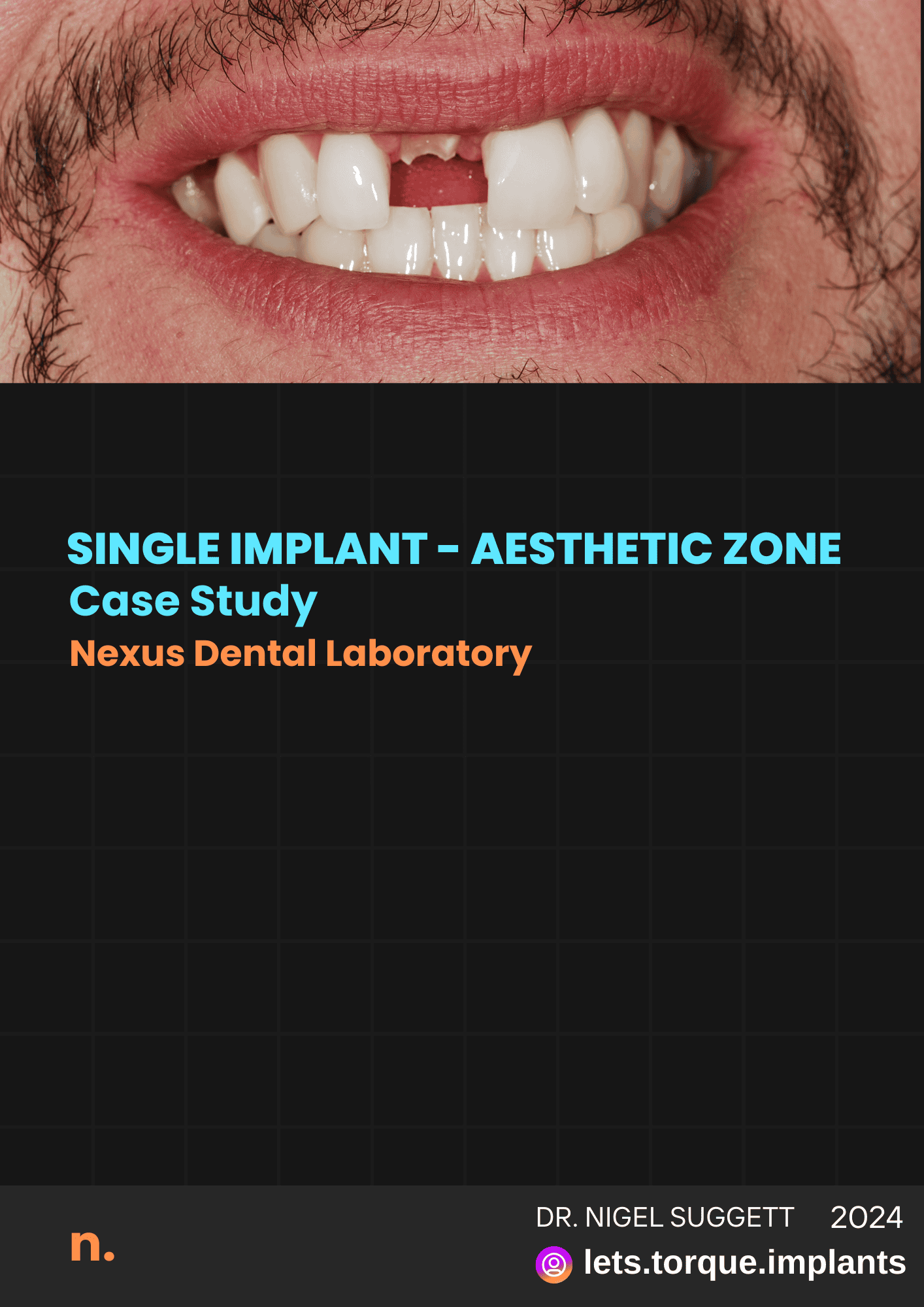 Dental implant case study, missing front tooth shown.