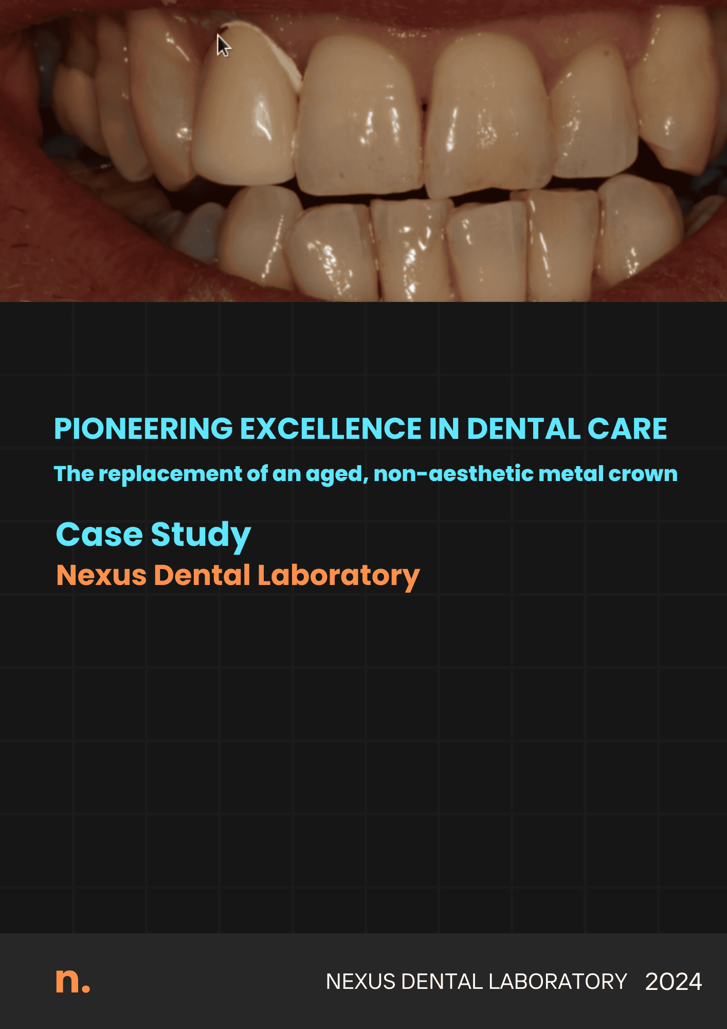 Dental care study on crown replacement.