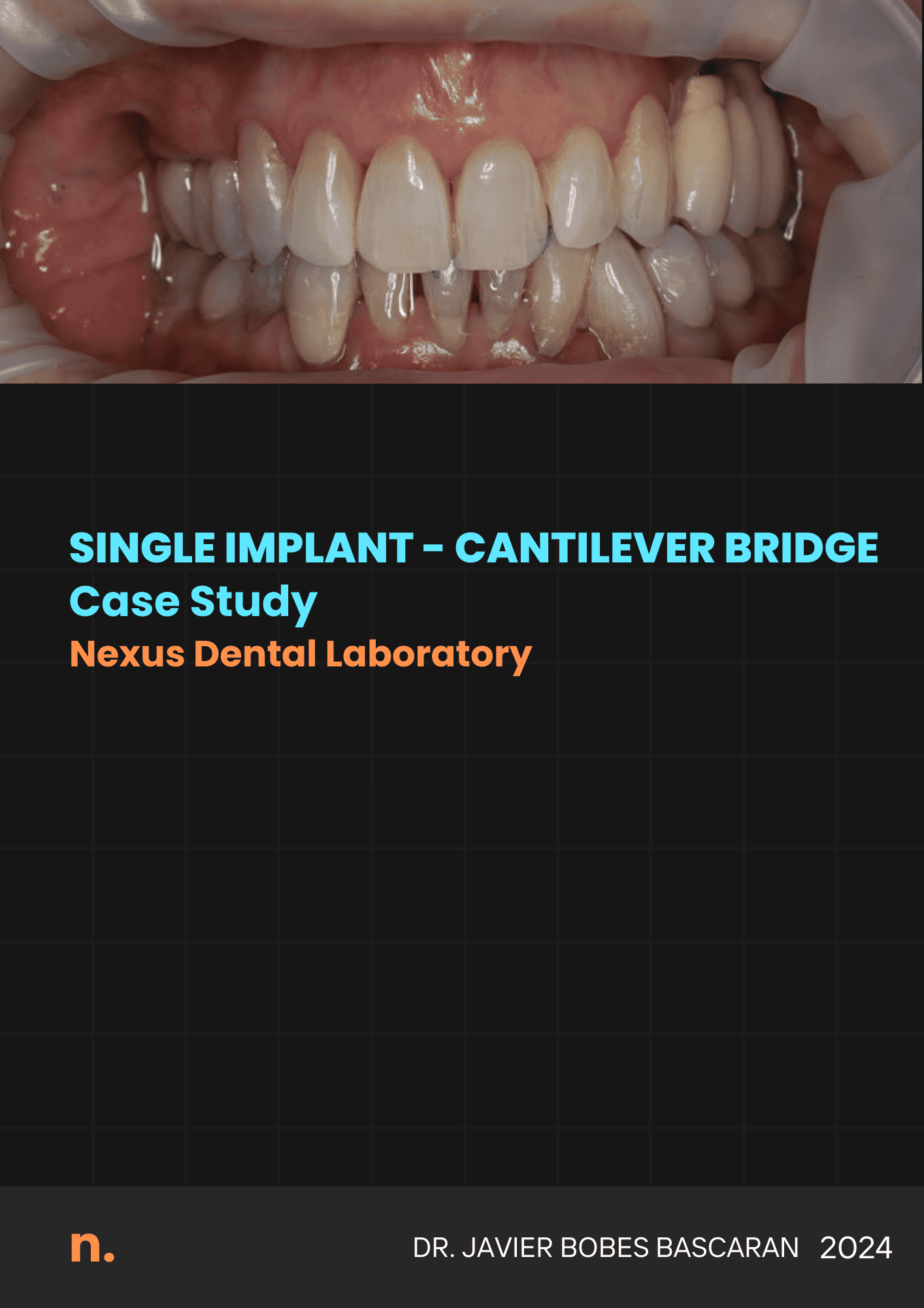 Dental implant cantilever bridge case study image