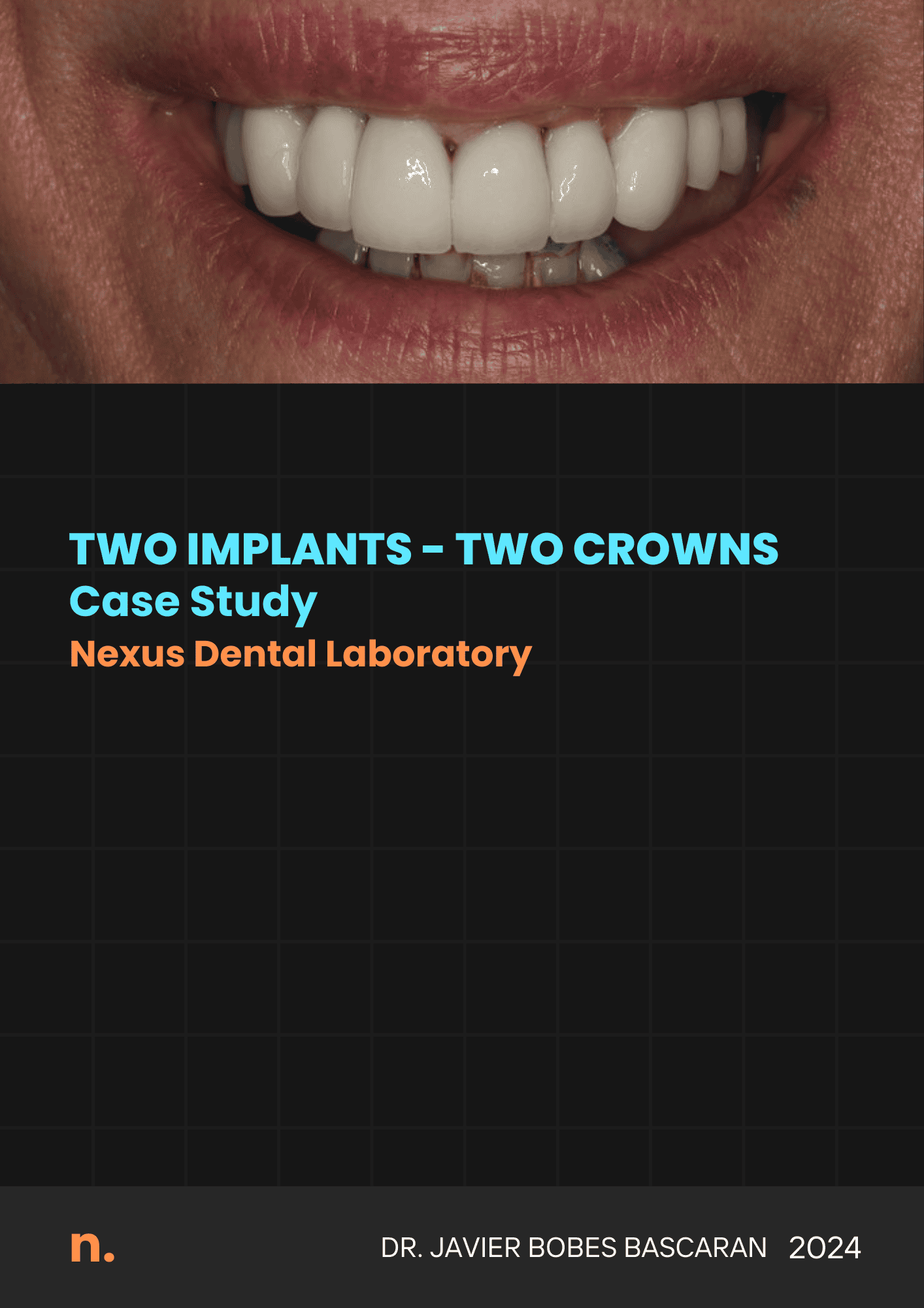 Dental implants and crowns case study 2024.