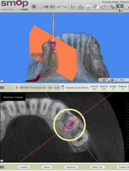 SMOP Dental implant planning software interface screenshot.