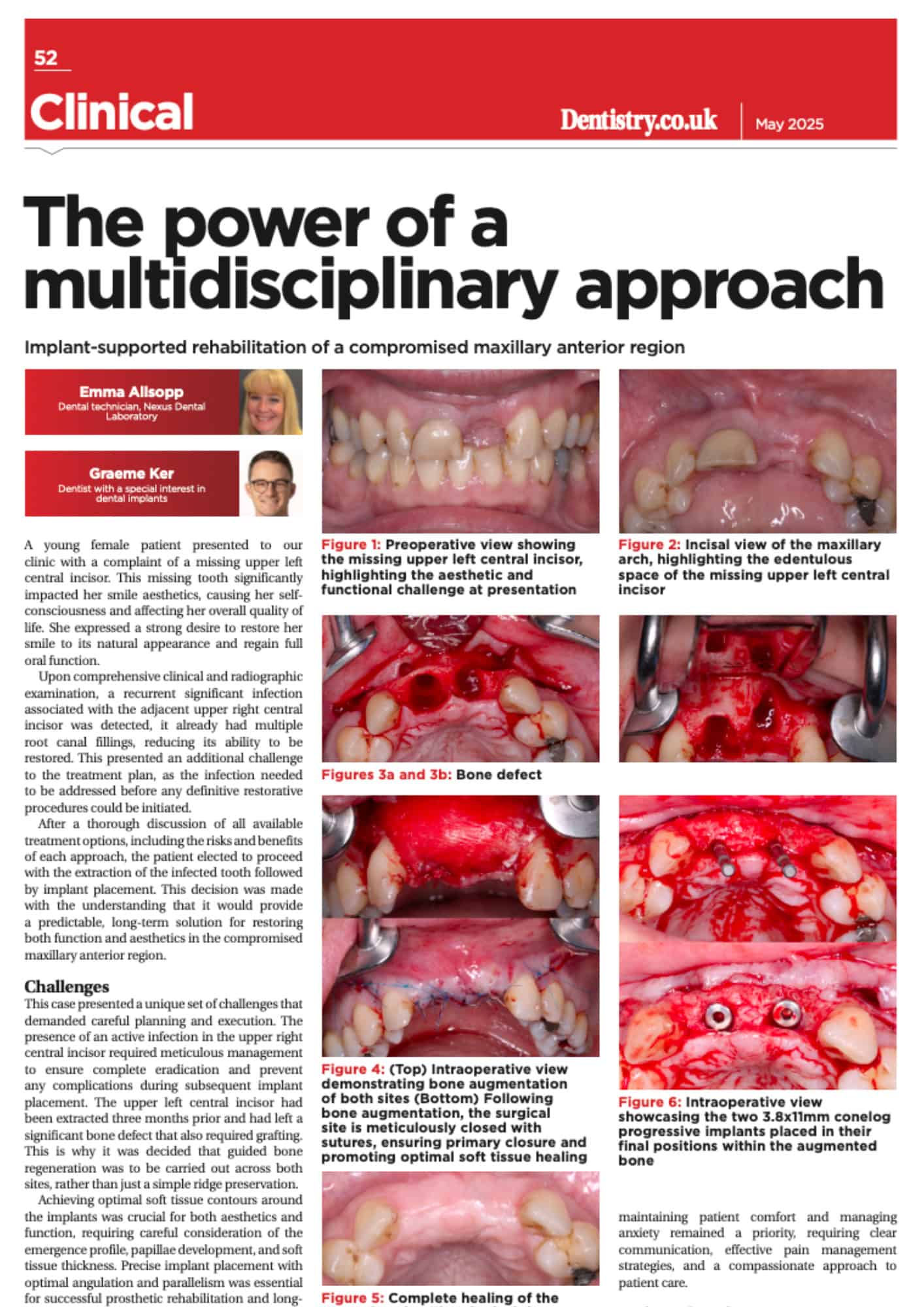 Dental implant rehabilitation process and results overview.